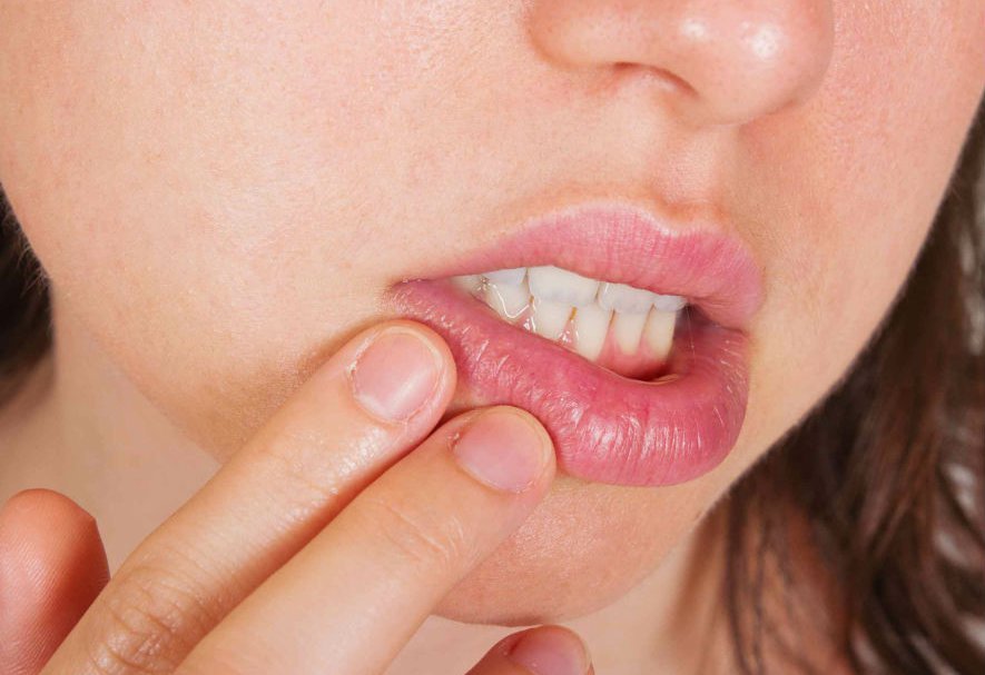 Afty w jamie ustnej – objawy, przyczyny, leczenie aft
