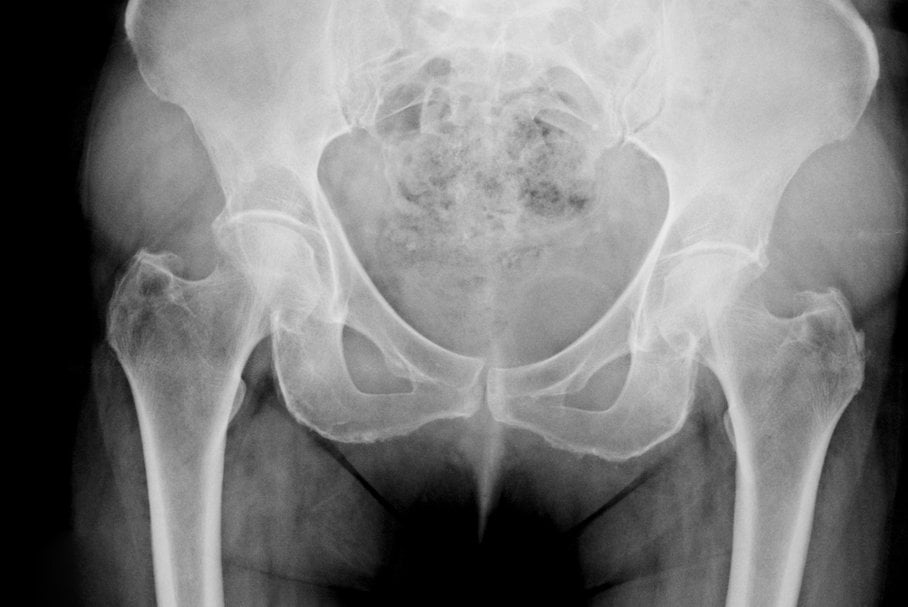 Zdjęcie rentgenowskie miednicy.