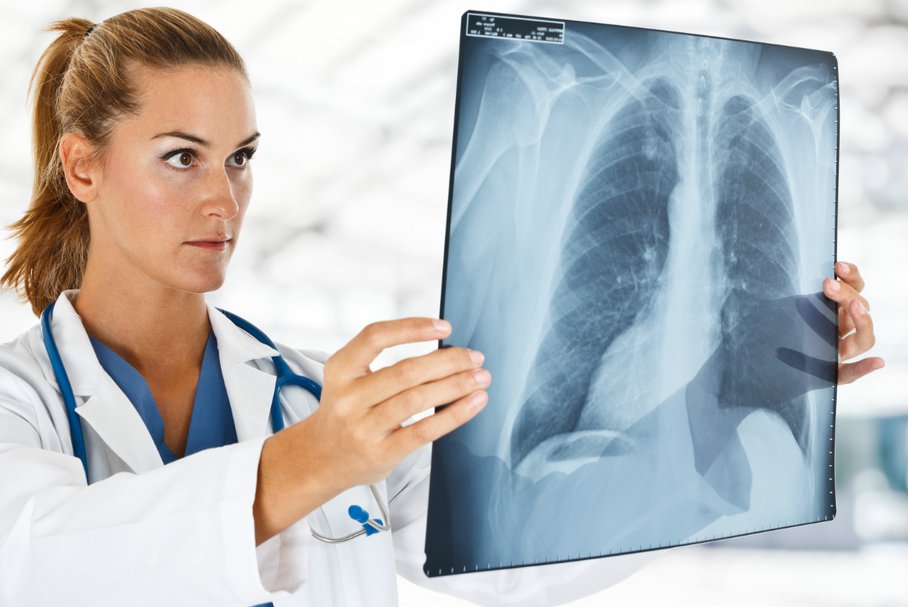 Zapalenie płuc – objawy i leczenie antybiotykiem i domowymi sposobami