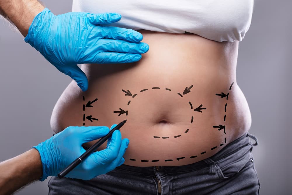 Abdominoplastyka – co to? Wskazania, przeciwwskazania, przebieg zabiegu, efekty, powikłania, cena