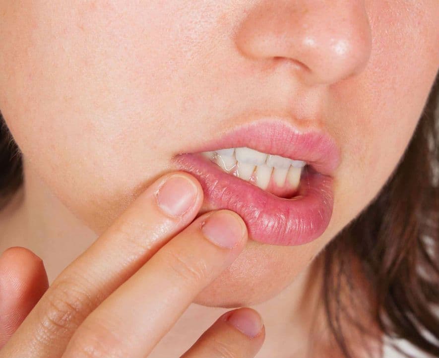 Zapalenie okołoustne (Dermatitis perioralis) – przyczyny, objawy, leczenie