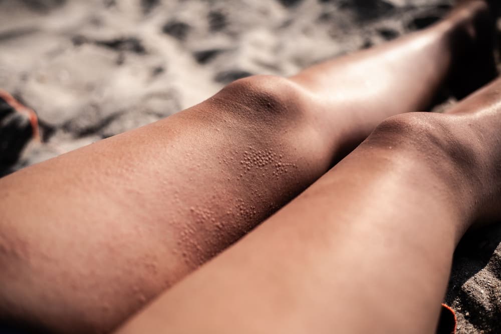 Alergia na słońce – jakie są objawy uczulenia na słońce i jak wygląda leczenie?