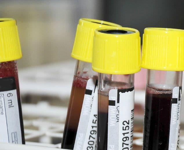 Anizocytoza – badanie RDW – co to jest za wskaźnik?