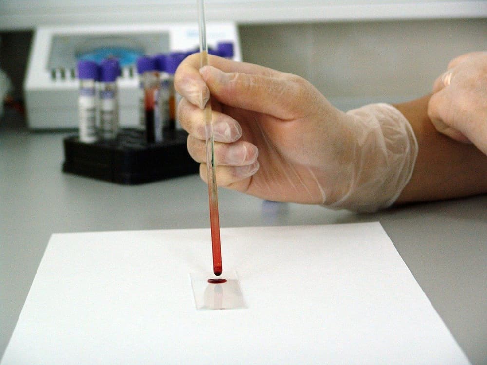 Poikilocytoza – nietypowy kształt erytrocytów w rozmazie (badaniu) krwi
