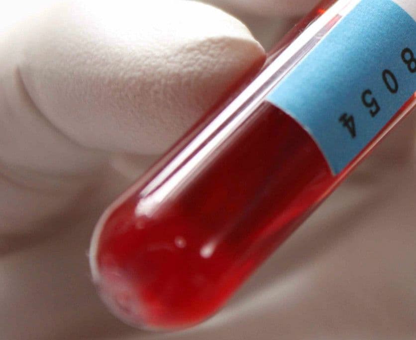 Niski sód – co oznacza niski (obniżony) poziom sodu – przyczyny, objawy, leczenie