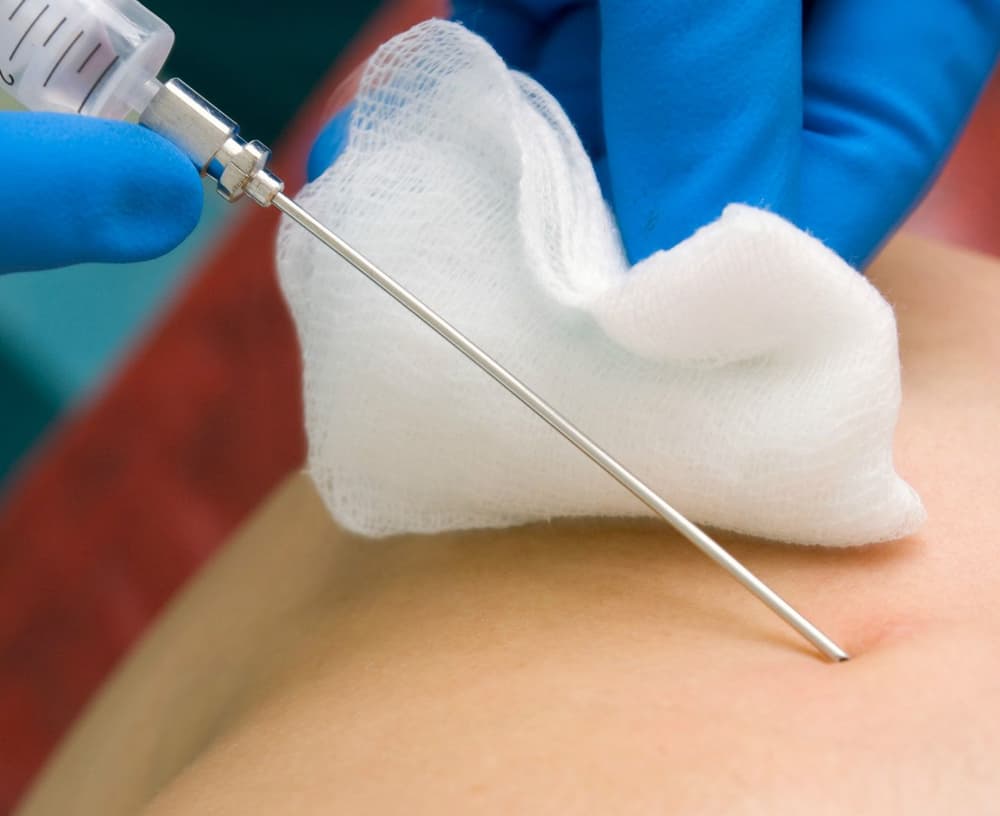 Biopsja – rodzaje, wskazania, przebieg i ryzyko powikłań