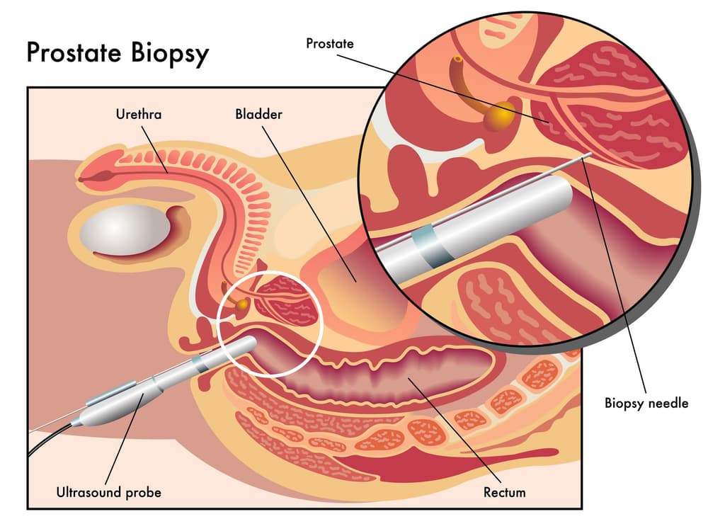 Biopsja prostaty – jak wygląda, jak się przygotować, czy boli, jakie są powikłania?