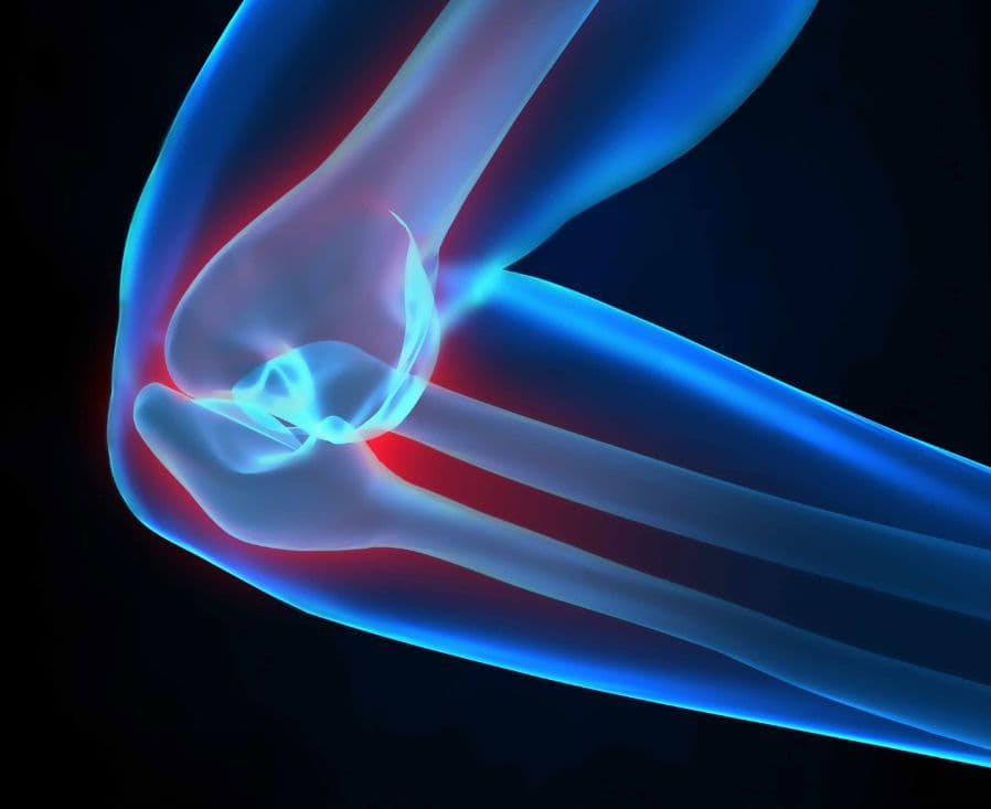 Ból łokcia – przyczyny bólu łokcia i jego chorób. Objawy, leczenie bólu i rehabilitacja