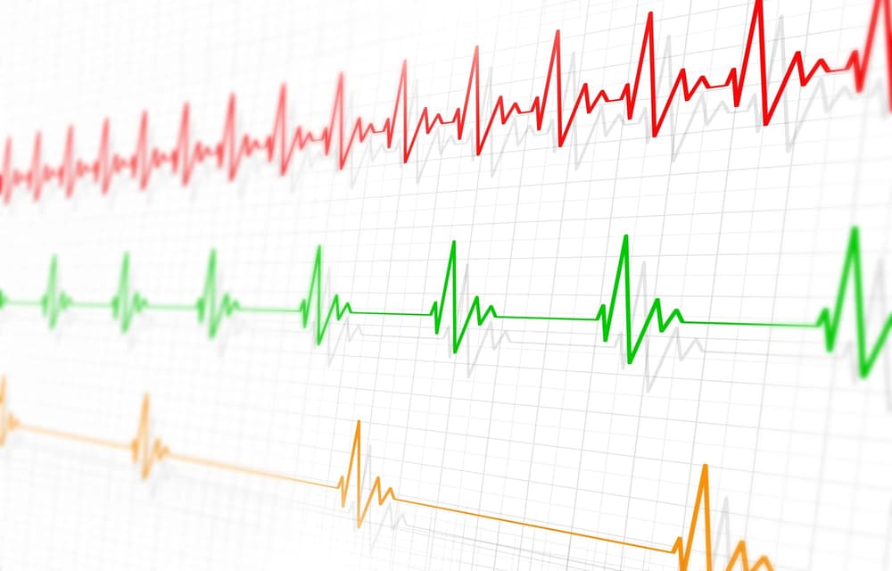 Bradykardia zatokowa (spowolniona akcja serca) – przyczyny, objawy, leczenie