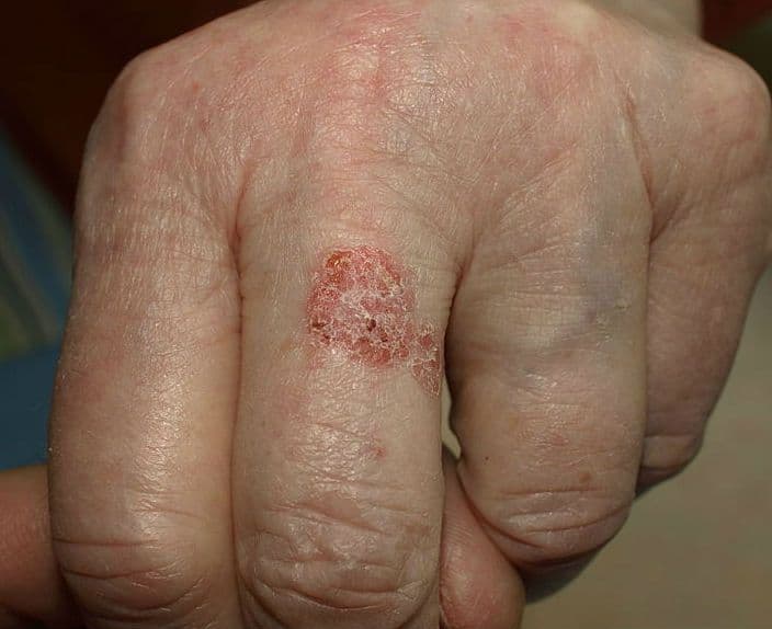 Choroba Bowena – przyczyny, objawy, leczenie, rozpoznanie, rokowania