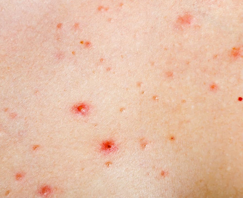 Choroba Schönleina–Henocha