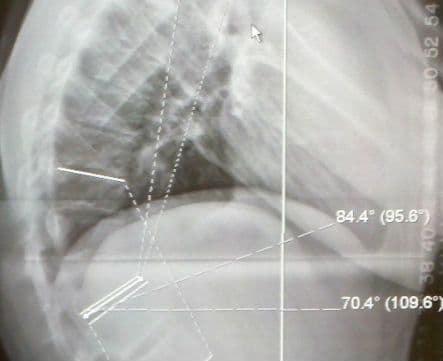 Choroba Scheuermanna – przyczyny, objawy, badania, leczenie, operacja, rehabilitacja, ćwiczenia