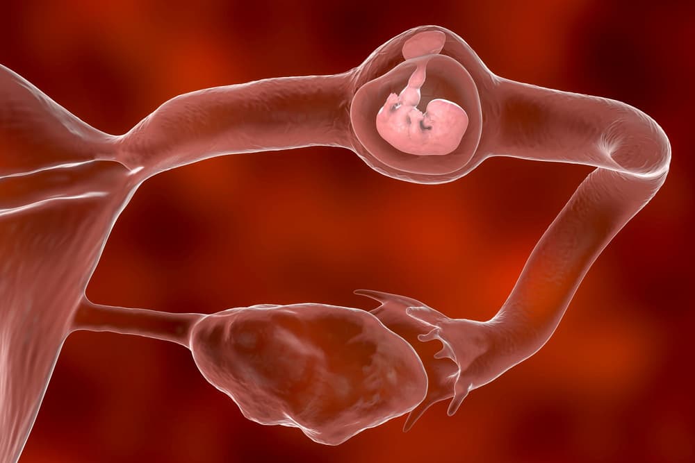 Ciąża pozamaciczna (ektopowa) – objawy, diagnostyka, czynniki ryzyka