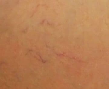 Co oznaczają pajączki na nogach – jak leczyć takie zmiany?