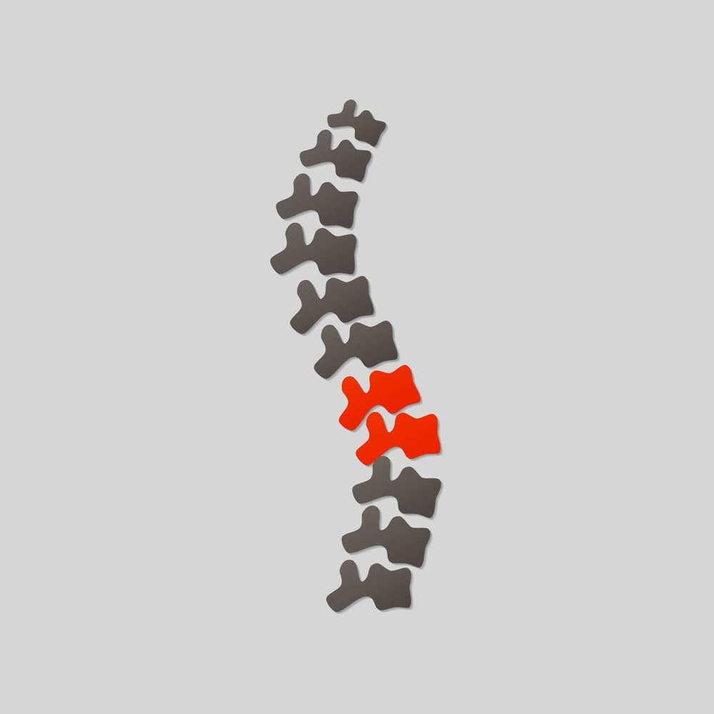 Dyskopatia lędźwiowa – przyczyny, objawy, leczenie, operacja, ćwiczenia, rehabilitacja, zapobieganie