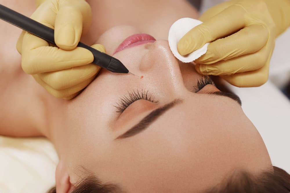 Elektrokoagulacja – wskazania, przeciwwskazania, przebieg zabiegu, efekty, skutki uboczne, cena