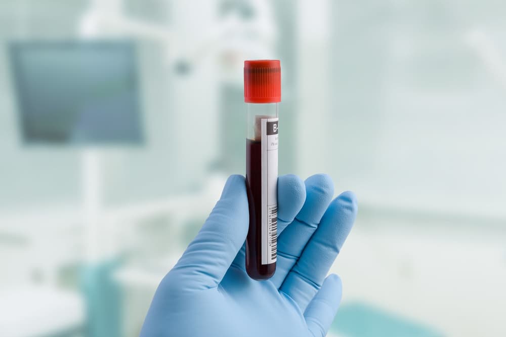 Dihydrotestosteron – badanie, wyniki, normy hormonu DHT