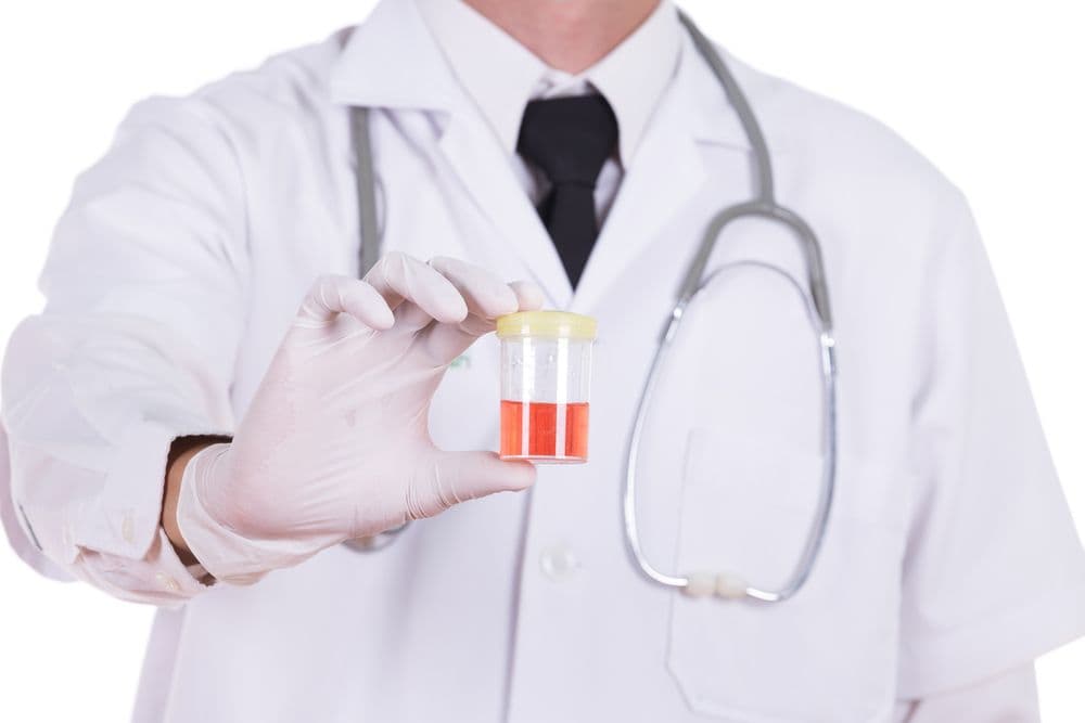 Erytrocyty świeże w moczu – jakie są przyczyny obecności krwinek czerwonych w moczu?