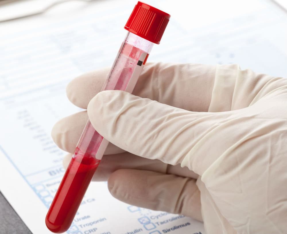 Fenyloketonuria – objawy, przyczyny, dziedziczenie, leczenie i dieta dla dziecka