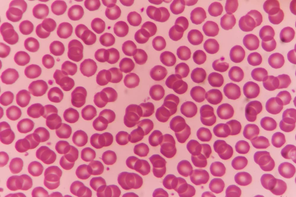 Anemia aplastyczna – co to jest, jakie są objawy, badania i leczenie?