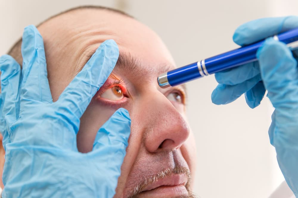 Jaglica (trachoma) – przyczyny, objawy, przebieg, leczenie
