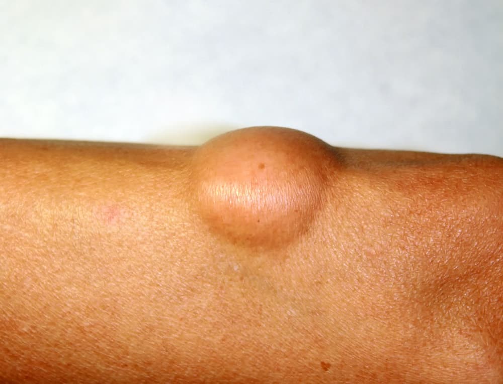 Tłuszczakomięsak – przyczyny, rodzaje, objawy, diagnostyka, leczenie, rokowanie