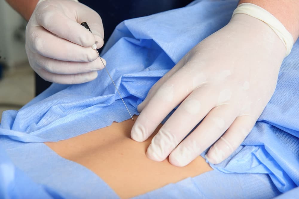 Ból głowy po znieczuleniu w kręgosłup – jakie są przyczyny i jak leczyć?