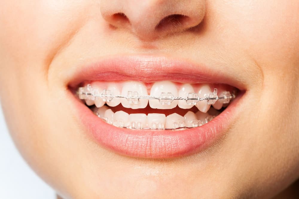 Clear Aligner (aparat przezroczysty) – wskazania, cena, zalety, wady