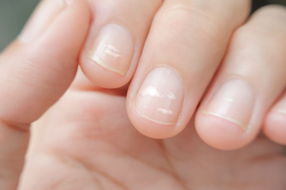 Bruzdy na paznokciach – jakie są przyczyny pofalowanej płytki paznokcia?