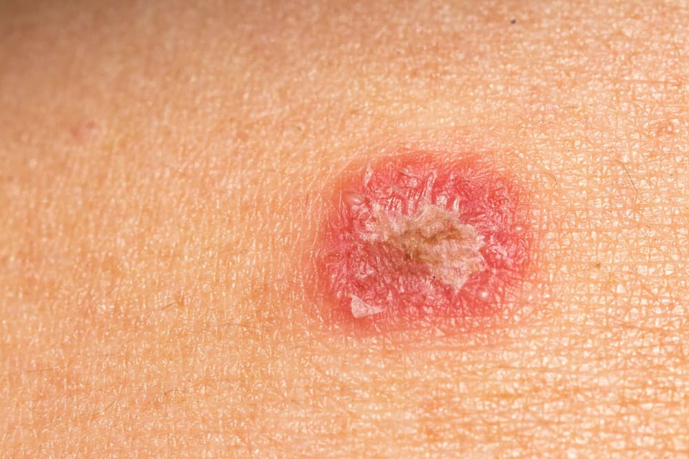 Dermatofity – co to jest, przyczyny zakażenia, rodzaje, badania, leczenie dermatofitozy