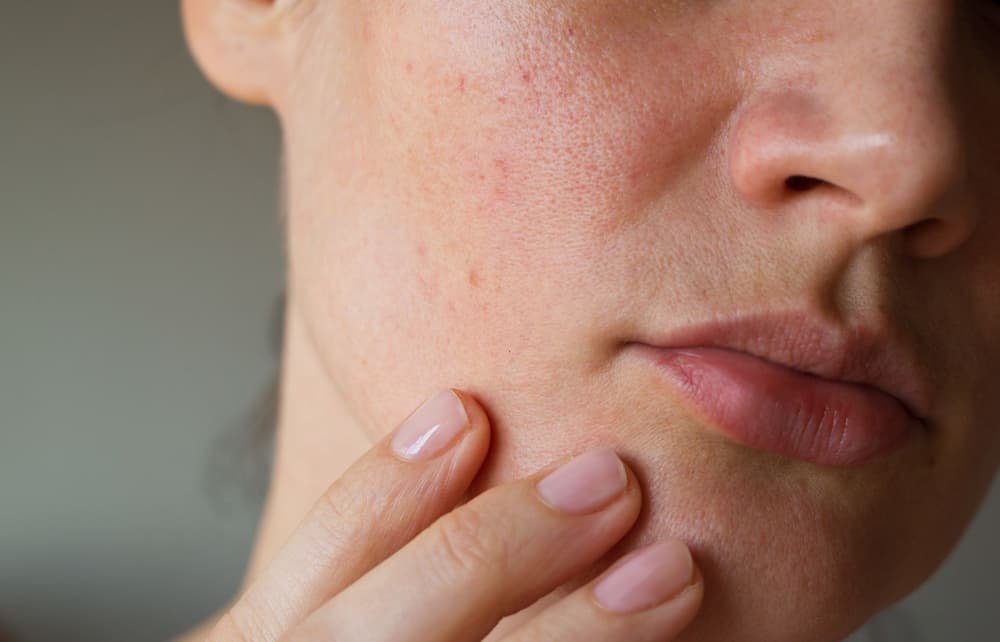 Zespół Sturge’a-Webera – przyczyny, objawy, diagnostyka, dziedziczenie, leczenie