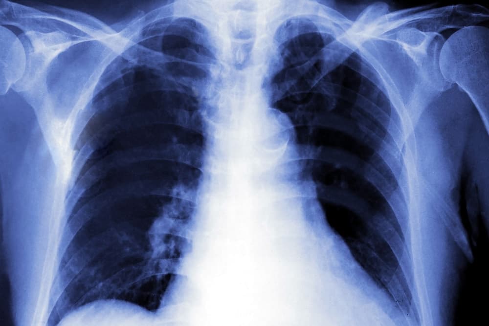 Mykoplazmatyczne zapalenie płuc – objawy, diagnostyka, leczenie i powikłania
