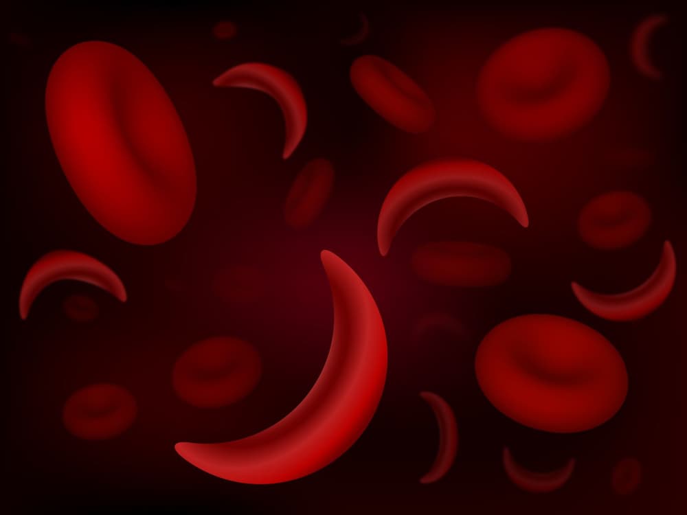 Anemia (niedokrwistość) sierpowata (sierpowatokrwinkowa) – przyczyny, objawy, leczenie