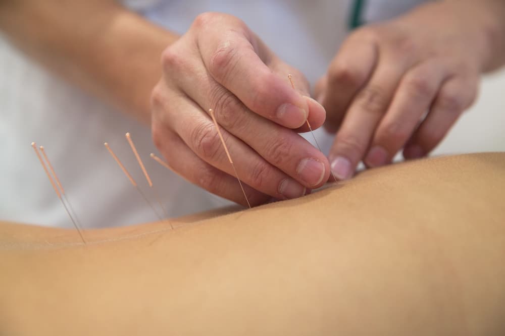 Suche igłowanie (dry needling) – co to jest, czy boli, wskazania, przeciwwskazania
