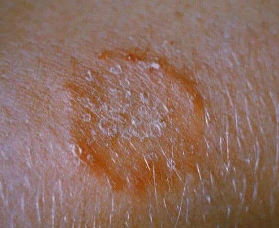 Grzybica woszczynowa – przyczyny, objawy, diagnostyka, przebieg i leczenie