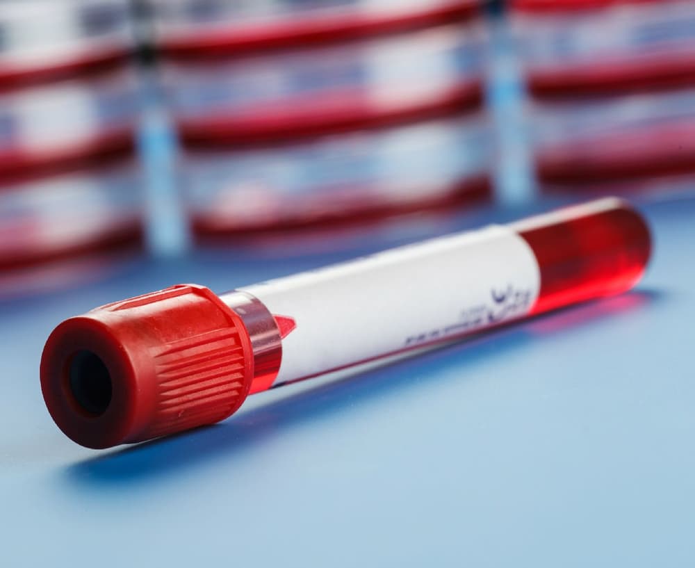 Hipertrójglicerydemia