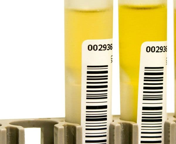 Immunofiksacja białek w moczu