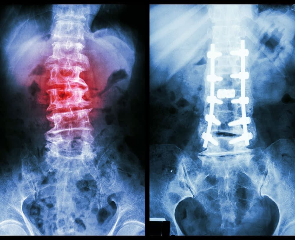 Kręgozmyk – przyczyny, objawy, rodzaje, stopnie, leczenie spondylolistezy
