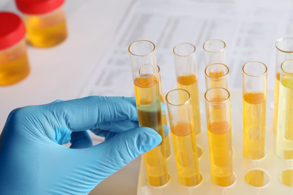 Kryptopiroluria (KPU) – co to jest, objawy, diagnostyka, leczenie, jaka dieta?