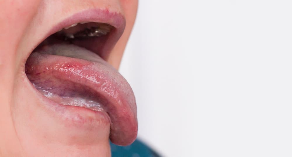 Leukoplakia – przyczyny, objawy, leczenie stanu przedrakowego jamy ustnej