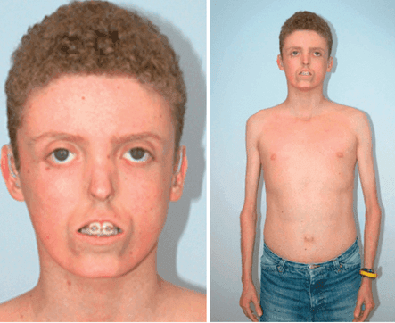Lipodystrofia