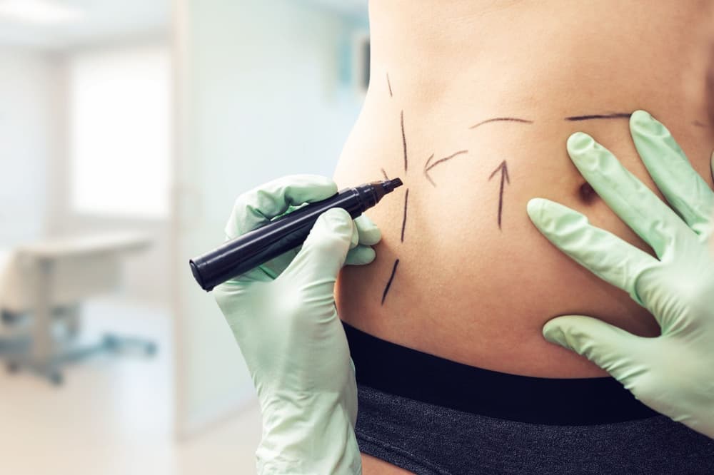 Liposukcja – brzucha, ud, pośladków – powikłania, opinie, cena