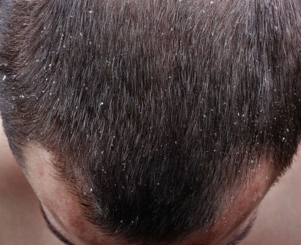 Łojotok – jakie są przyczyny, objawy i leczenie wydzielania nadmiaru sebum?