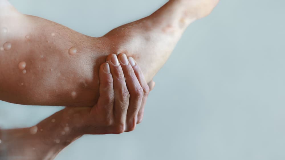 Małpia ospa (mpox) – przyczyny, objawy, leczenie, jak rozpoznać wirus małpiej ospy?