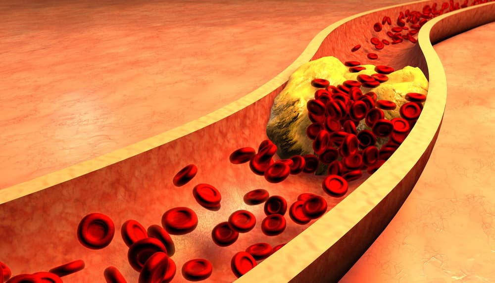 Cholesterol a miażdżyca tętnic – jaki jest związek?