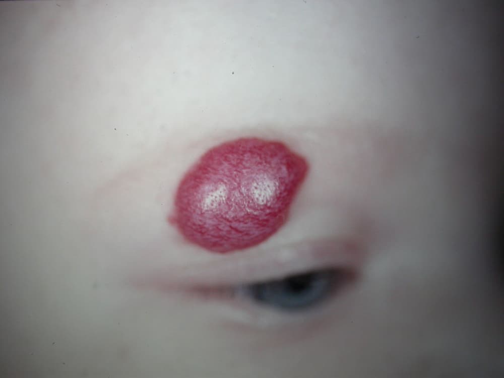 Naczyniak jamisty – przyczyny, objawy, diagnostyka, leczenie, rokowania