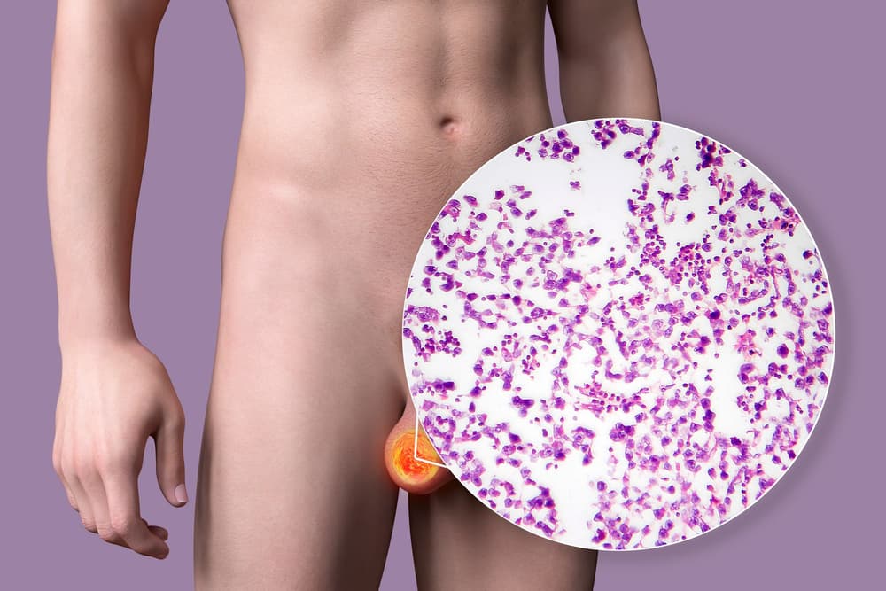 Nasieniak (seminoma) – przyczyny, objawy, badania, leczenie, rokowania