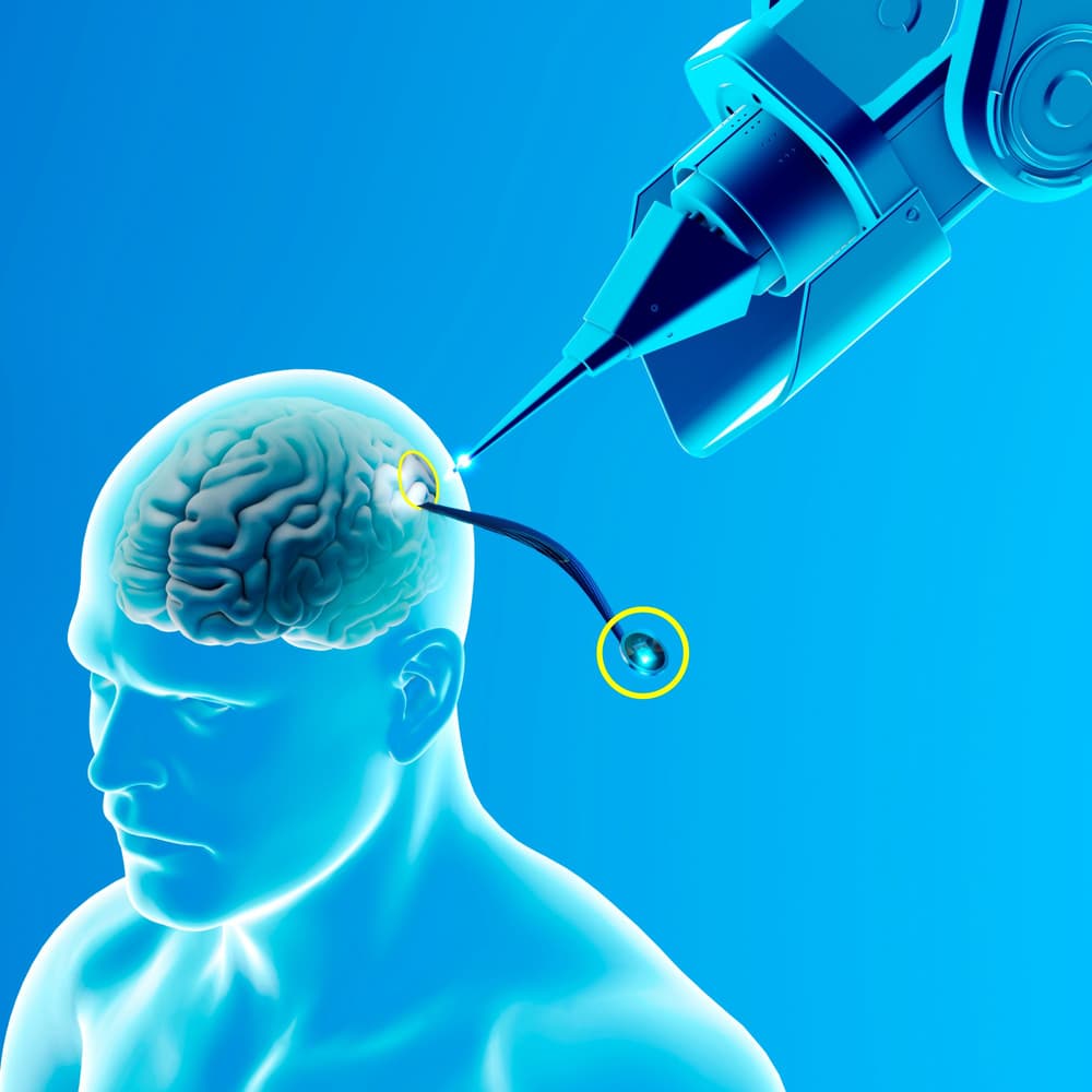 Neuralink – czym jest implant mózgowy, jak działa i w jakich chorobach może pomóc?