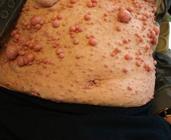 Neurofibromatoza – przyczyny, objawy, diagnostyka, leczenie