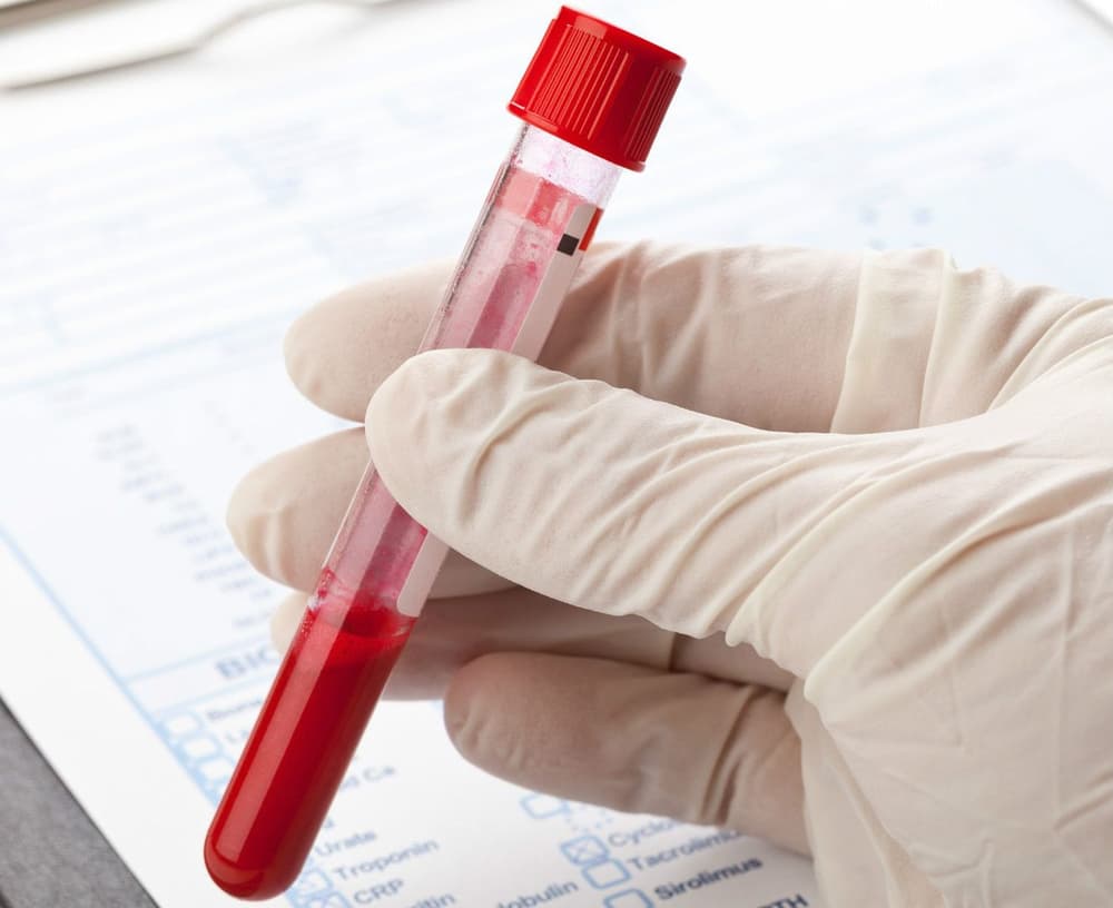Krioglobulinemia – przyczyny, objawy, diagnostyka, leczenie